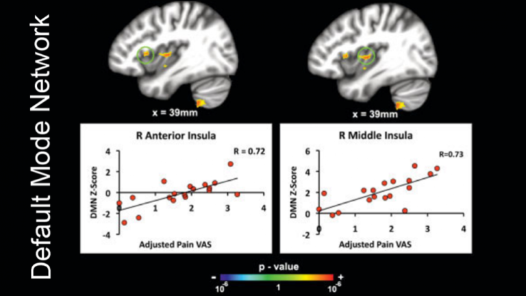Napadow et al., Arthritis & Rheumatism 2010 Fibromyalgia patients exhibit increased functional connectivity between DMN and insula - a marker for spontaneous pain intensity
