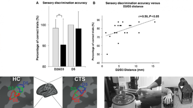 Maeda et al., Brain 2014 Reduced 2nd/3rd interdigit cortical separation in primary somatosensory cortex underlies deficits of Carpal Tunnel Syndrome