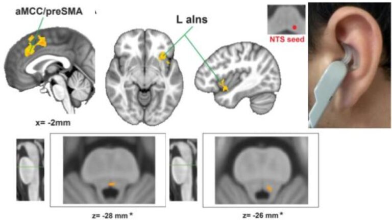 Garcia et. al., Pain 2017 eRAVANS modulates NTS functional connectivity and activation of 5-HT and NA nuclei to airpuff in migraine patients