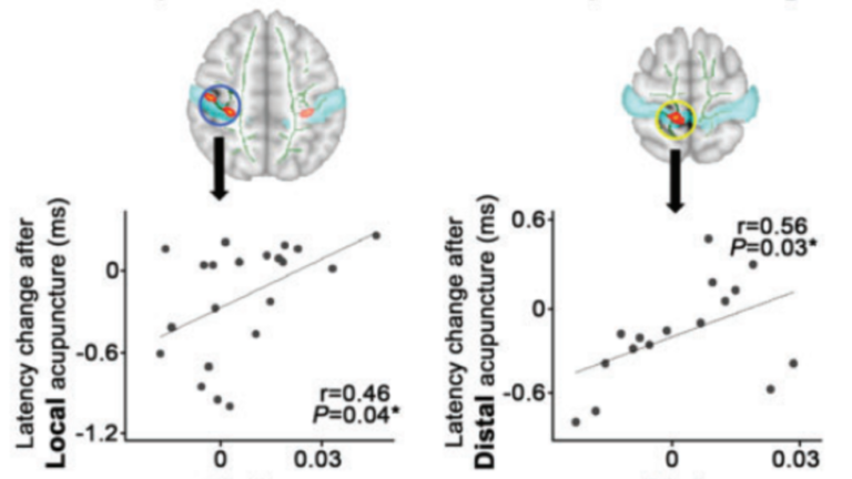 Maeda et. al., Brain 2017 Median nerve conduction latency correlates with fractional anisotropy changes following local and distal acupuncture in CTS