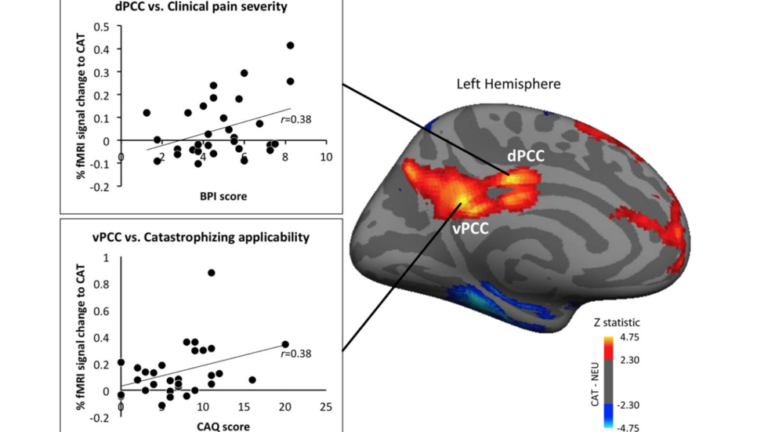 Lee et. al., Arthritis & Rheumatology 2018 Brain areas active when viewing catastrophizing vs neutral statements are related to clinical metrics in fibromyalgia patients