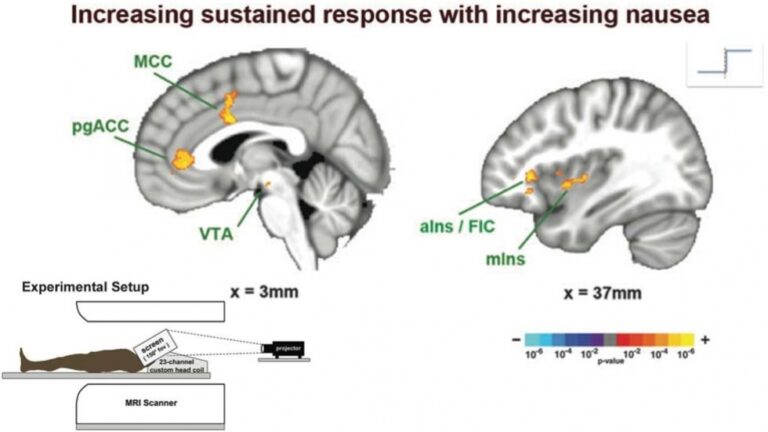 Napadow et al., Cerebral Cortex 2012 Brain activation supporting nausea perception - a novel approach for human neuroimaging